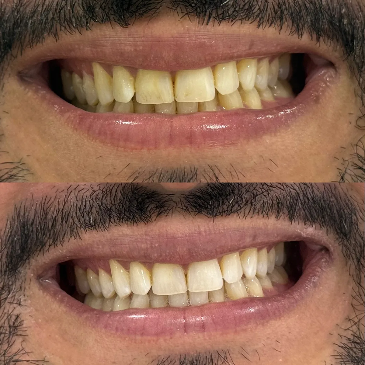Resultado clínico de clareamento dental — caso 2